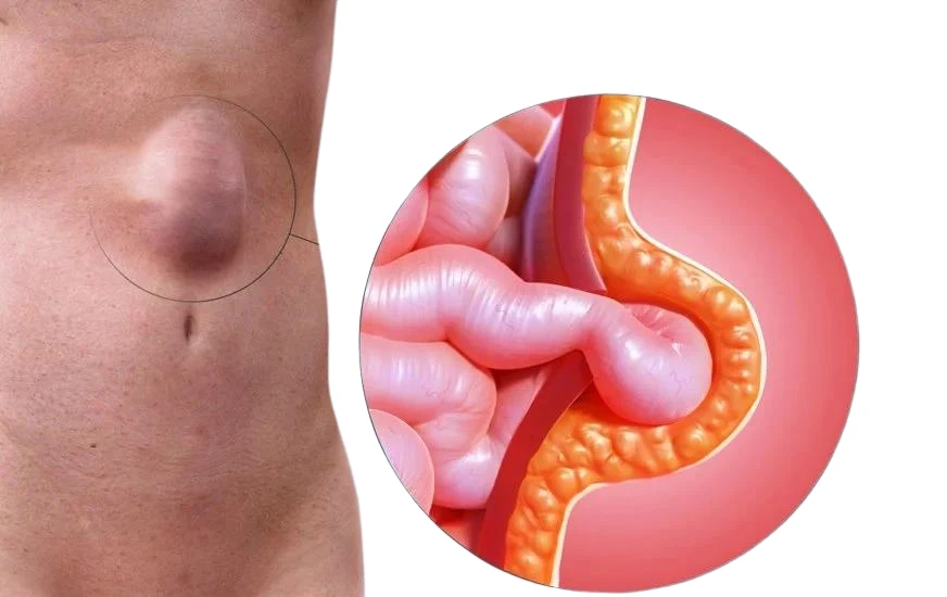 Hérnias Abdominais