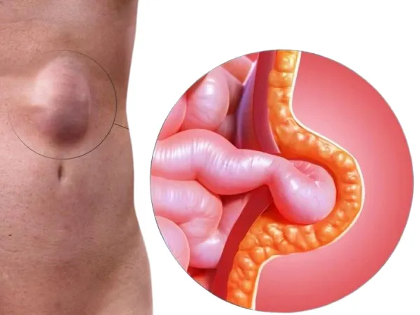 Hérnias Abdominais