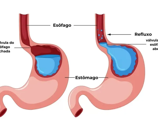 Doença do Refluxo Gastroesofágico (DRGE)
