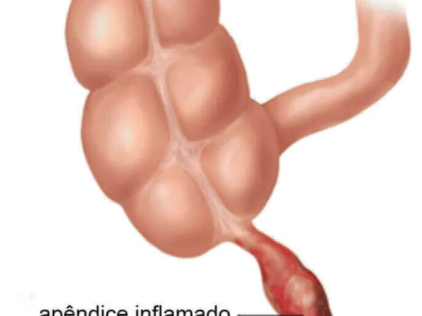 Apendicite Aguda